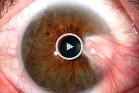 La Dra. Sauvageot nos habla del pterigion