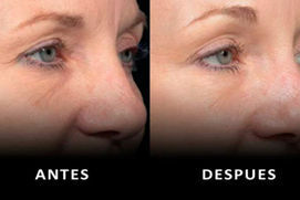 Rejuvenecer la mirada con el m&eacute;todo Thermage
