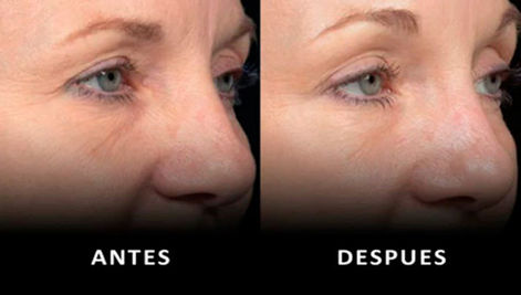 Rejuvenecer la mirada con el m&eacute;todo Thermage